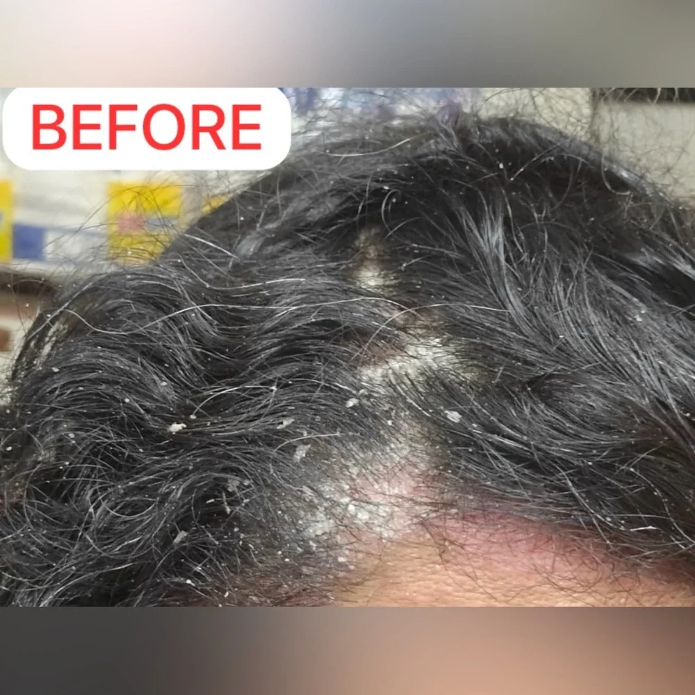 Nizoral Anti-Dandruff Shampoo - Picture 2 of 4